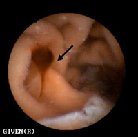 カプセル内視鏡がとらえた小腸内の画像。矢印の粘膜部分に出血が見られる